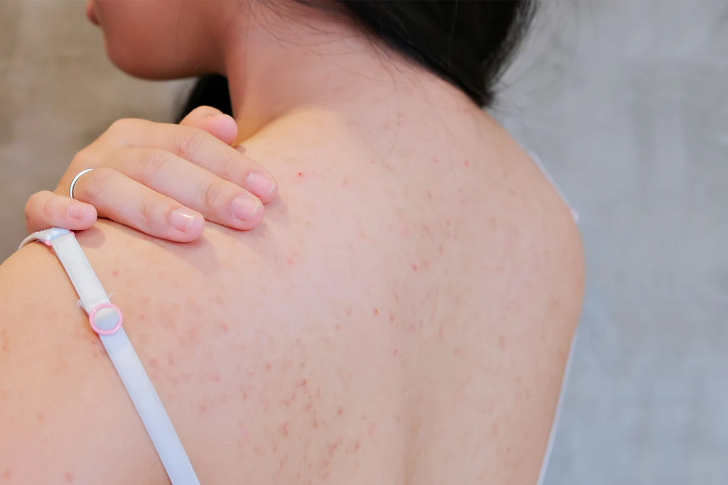 10 Ways To Treat Pimples on the Back